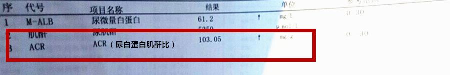 臨床目前最常用尿蛋白肌酐比來反應(yīng)尿微量白蛋白的水平