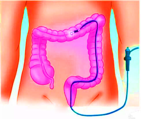 直腸癌早期有哪些癥狀？